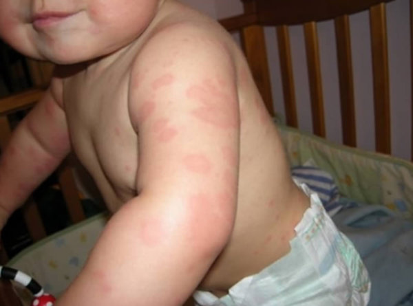Лечим аллергию на коже у ребенка