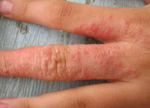 Как лечить аллергию на коже